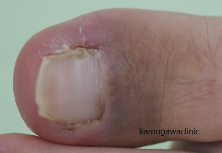 Fotografia de um caso pós-tratamento que mostra a melhoria das unhas encravadas e o alívio da inflamação após o método do fenol.
