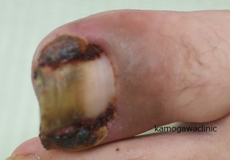 Fotografia de um caso de pré-tratamento de uma unha deprimida que faz com que a ferida não cicatrize, resultando em dor intensa e dificuldade em andar.