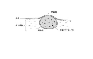 粉瘤シェーマ　かもがわクリニック天六