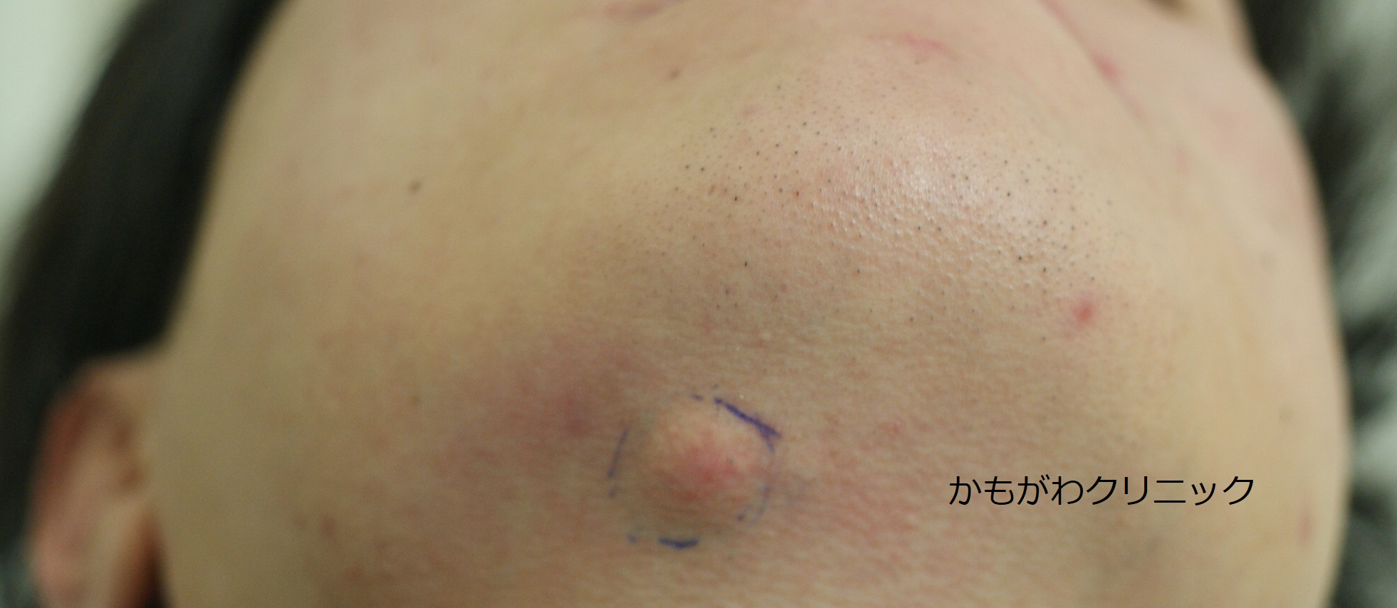 粉瘤 - SSクリニック - 皮膚科・美容外科 - 名古屋市中区 - Part 4